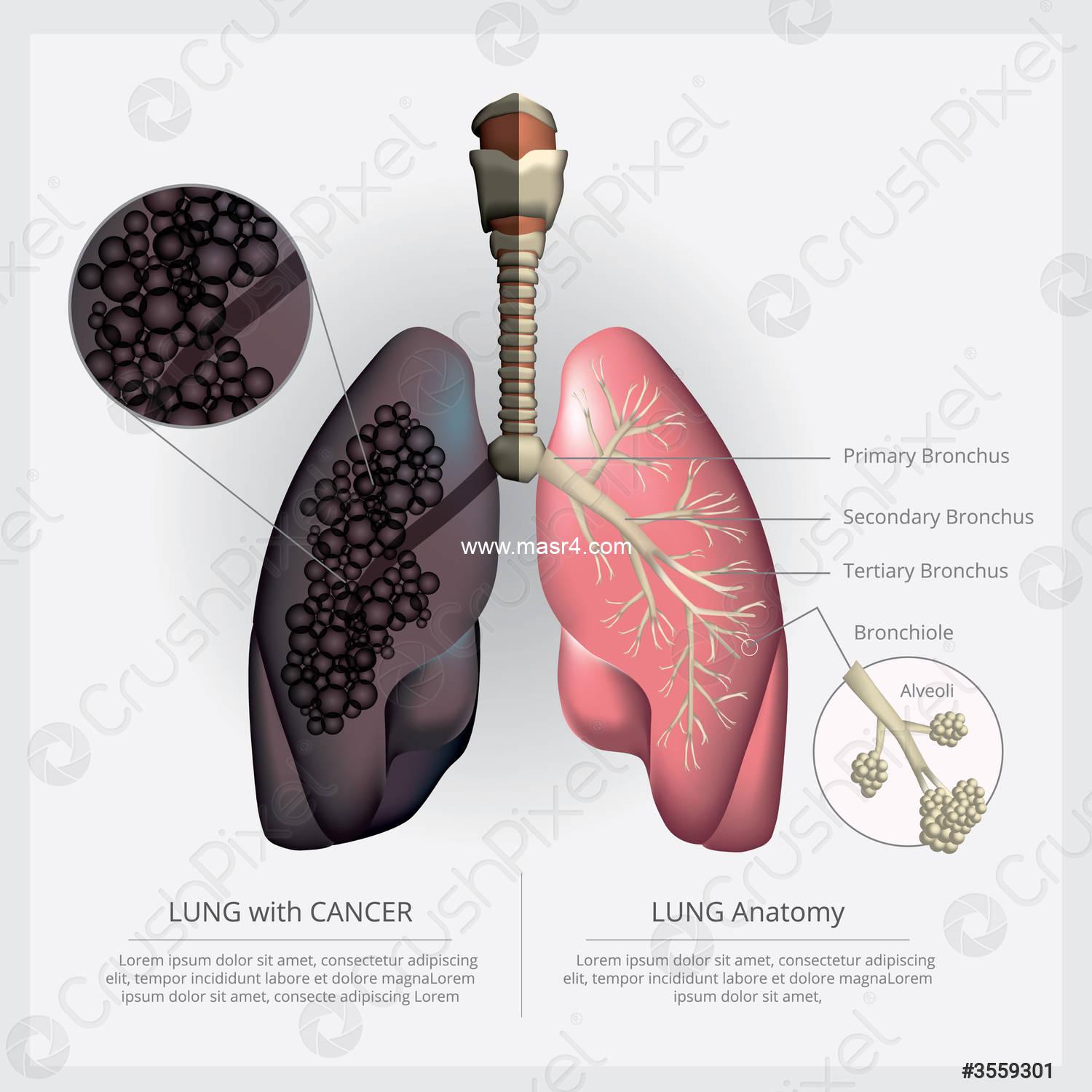 lung with detail lung cancer 3559301