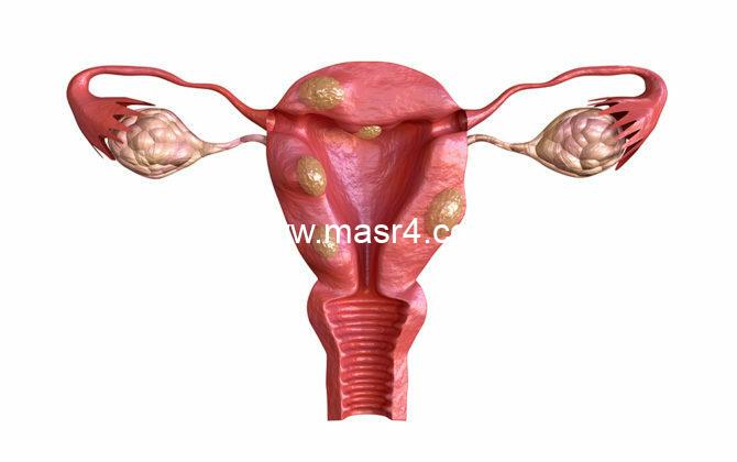 uterine fibroid are benign solid tumors formed by muscle tissue 670x420 1